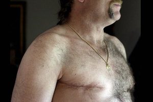 Man with breast cancer scar - Male breast cancer study - Source: www.statnews.com Patrick Semansky/AP